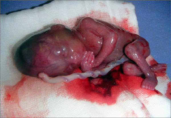aborto.jpg